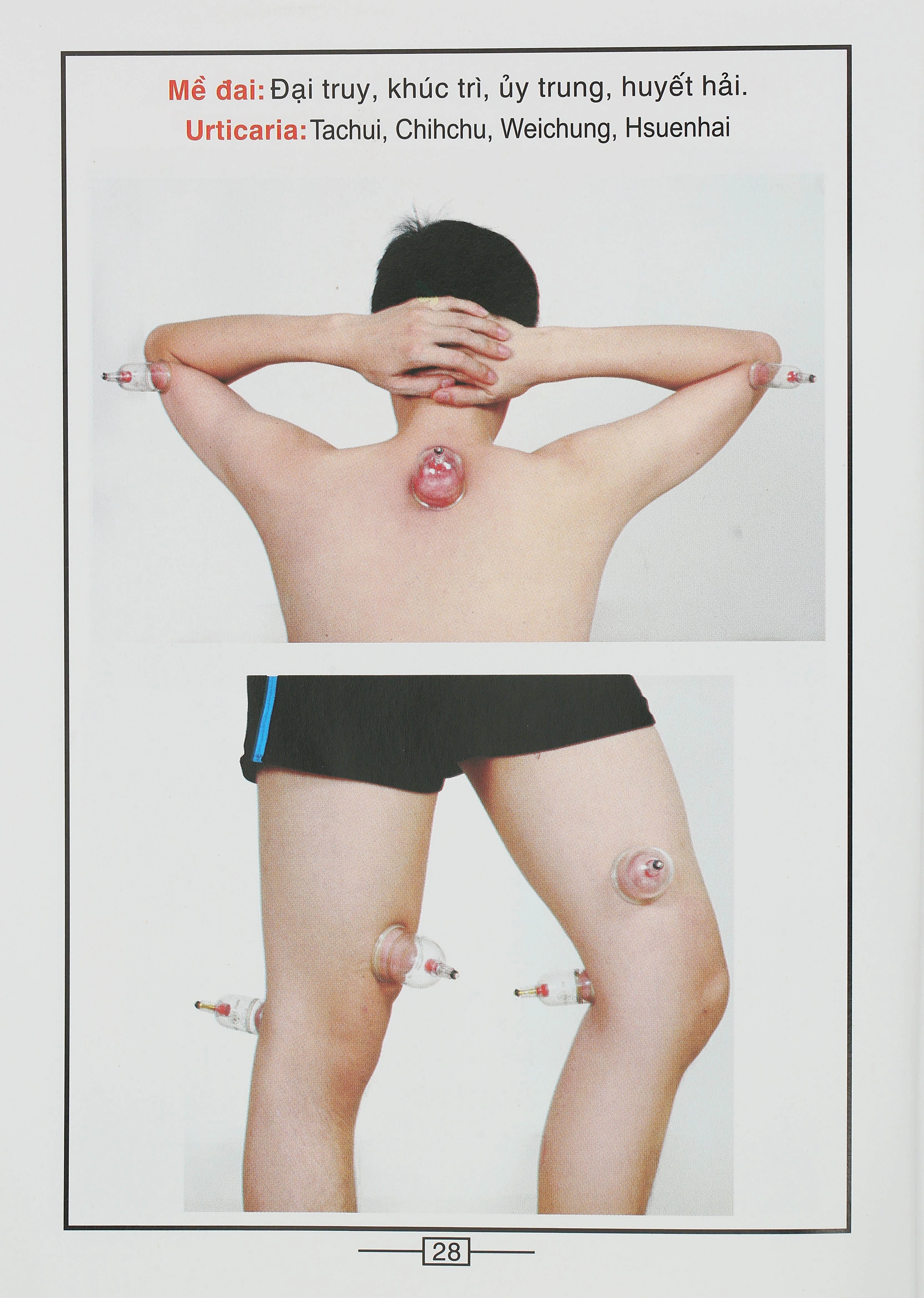 Bộ Giác hơi không dùng lửa Duy Thành YGH01 loại A - 21