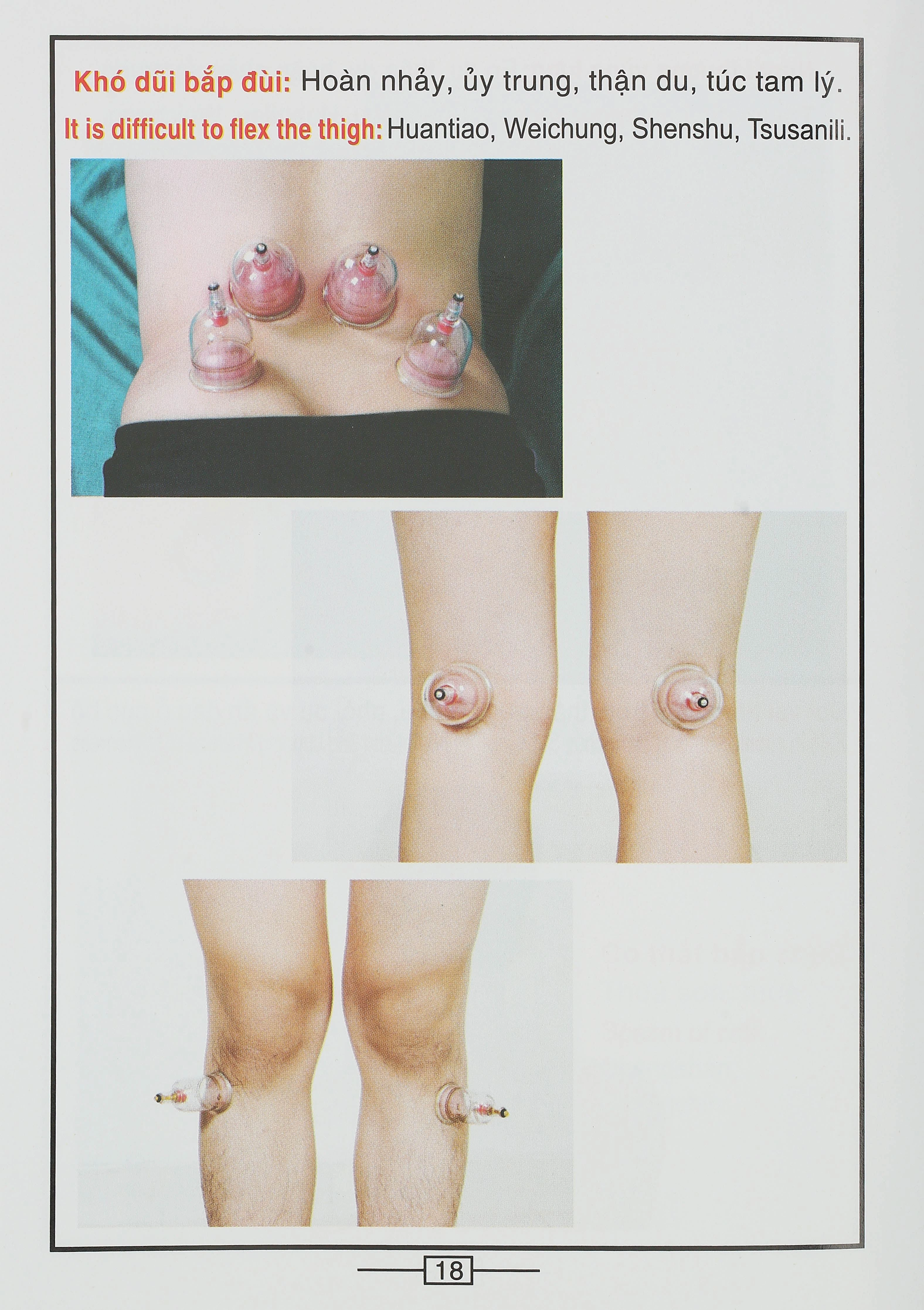 Bộ Giác hơi không dùng lửa Duy Thành YGH01 loại A - 31