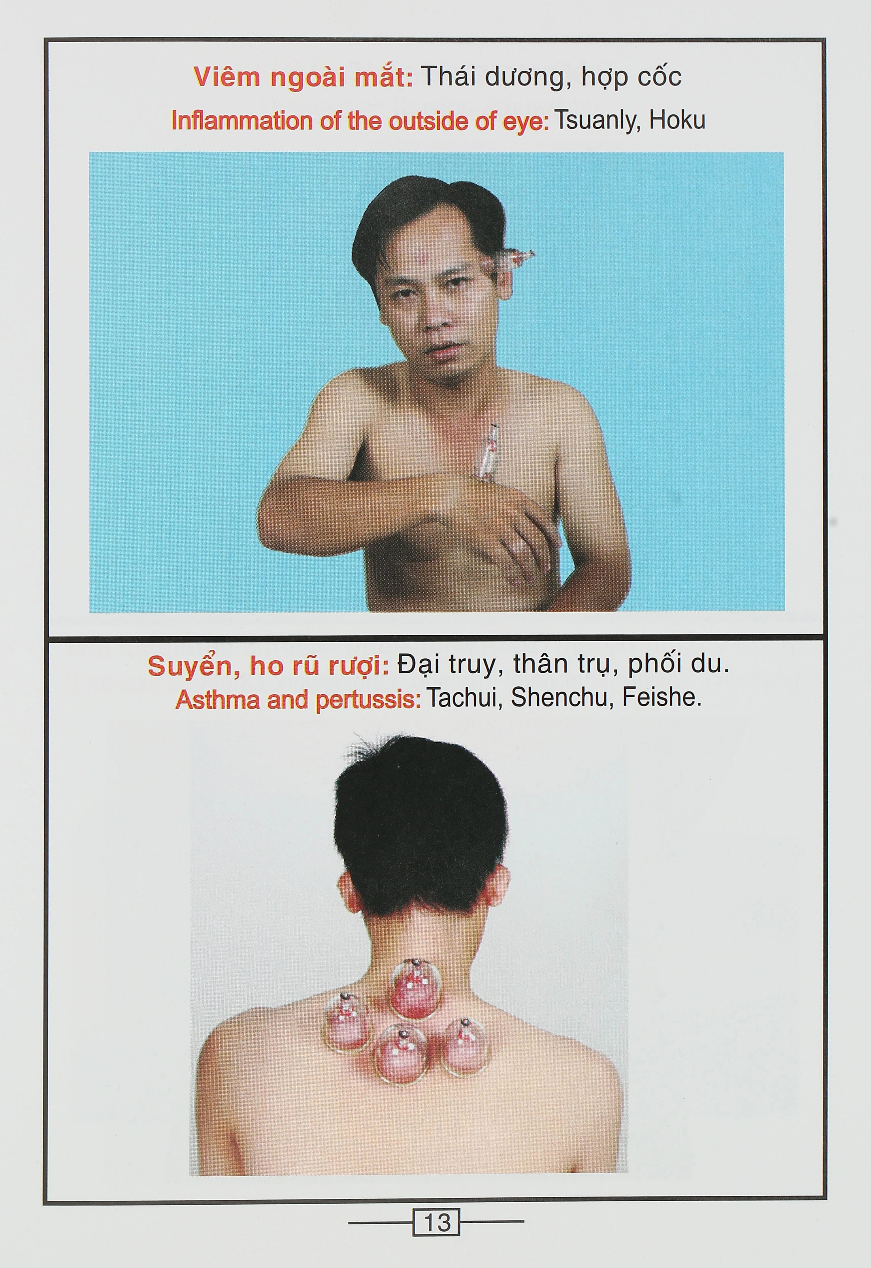 Bộ Giác hơi không dùng lửa Duy Thành YGH01 loại A - 36