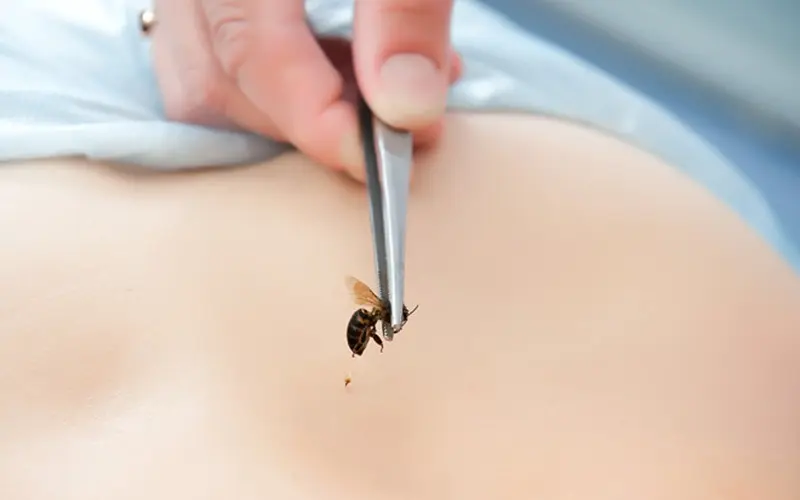 Thực hiện sơ cứu khi bị ong đốt
