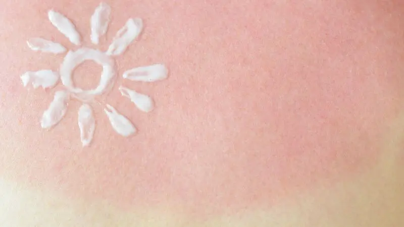 Khắc phục làn da bị cháy nắng