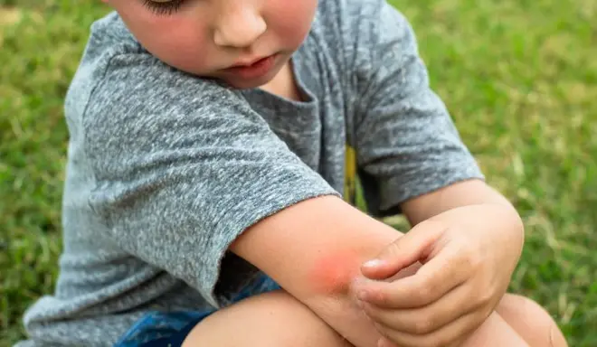 Nên làm gì khi trẻ bị bọ chét cắn? 10 cách trị bọ chét cắn tại nhà