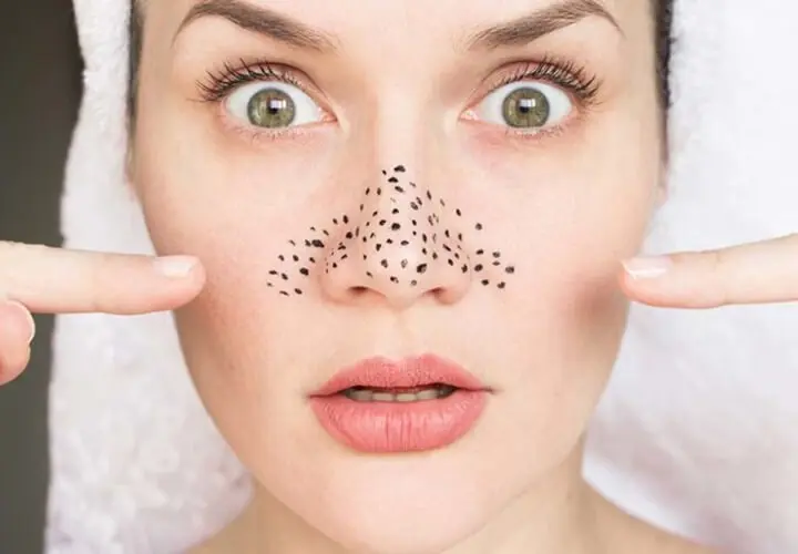 Máy phù hợp với vùng da có mụn đầu đen Máy phù hợp với vùng da có mụn đầu đen